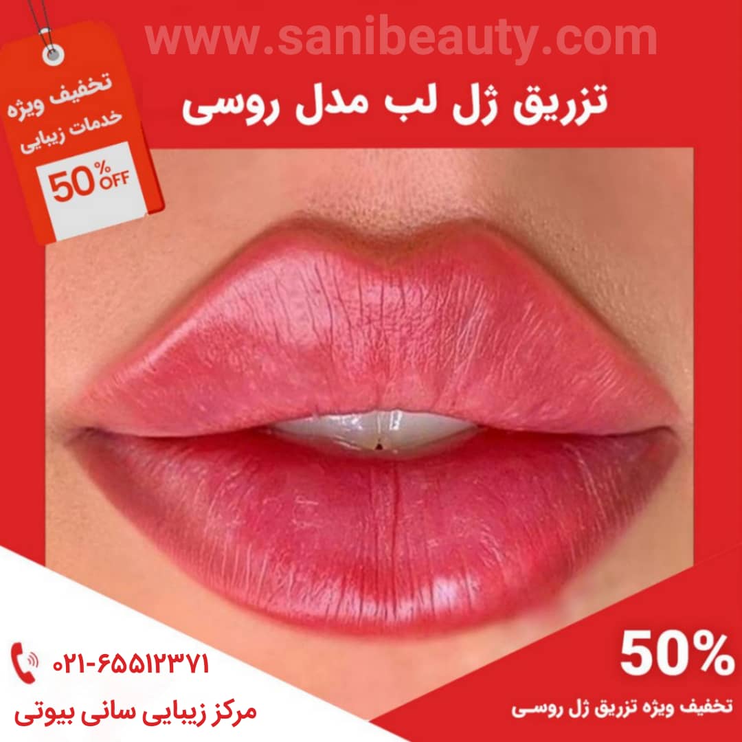 تکنیک تزریق ژل لب مدل روسی لیزر در اندیشه و شهریار 2308