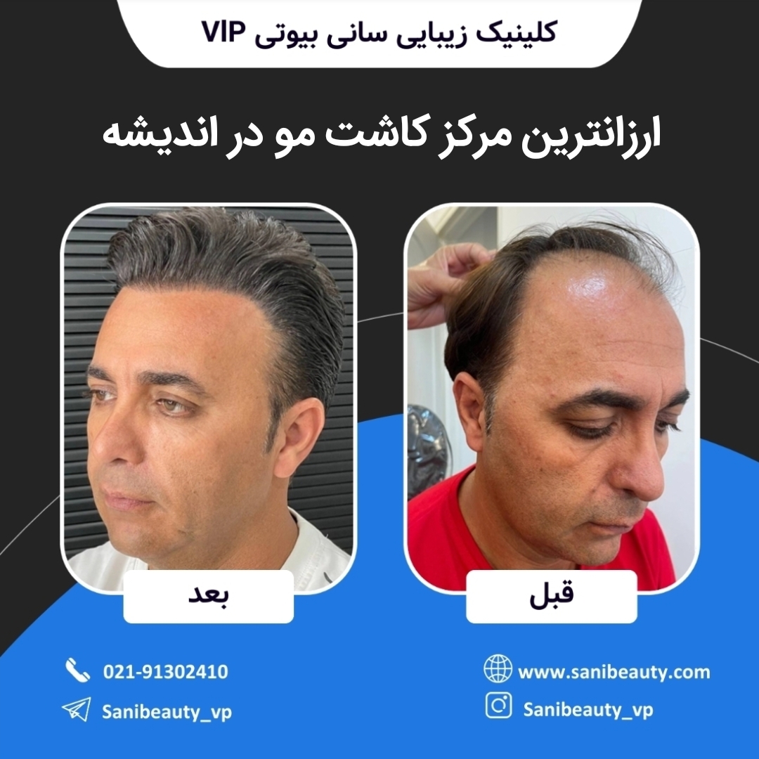 ارزانترین مرکز کاشت مو در اندیشه