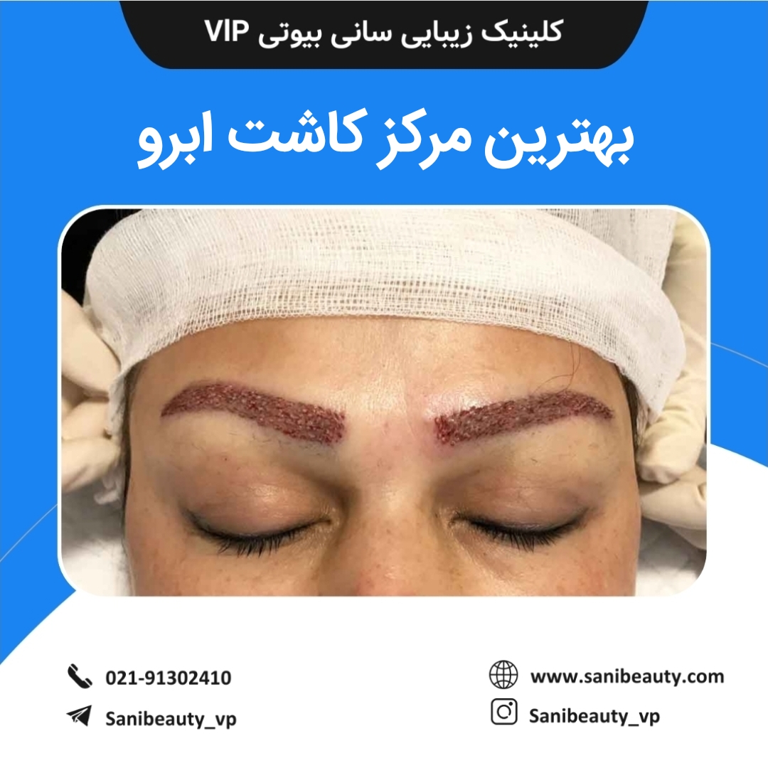 بهترین مرکز کاشت ابرو