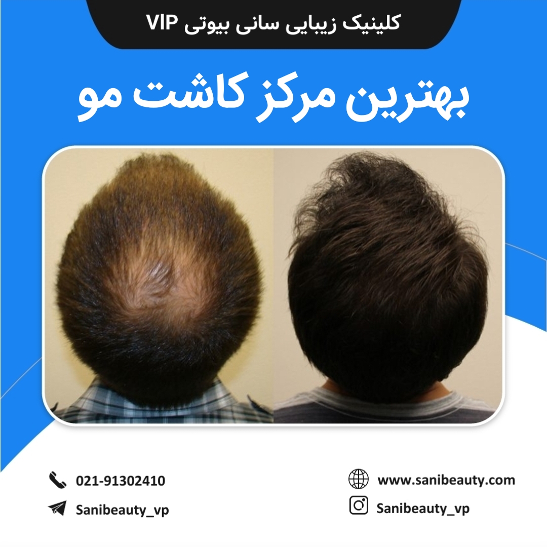 بهترین مرکز کاشت مو