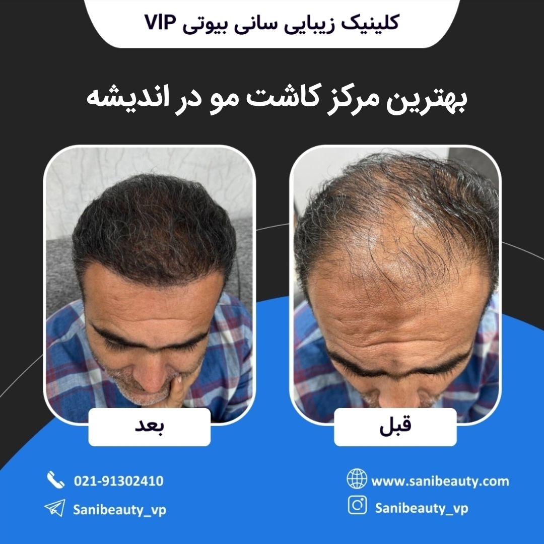 بهترین مرکز کاشت مو در اندیشه