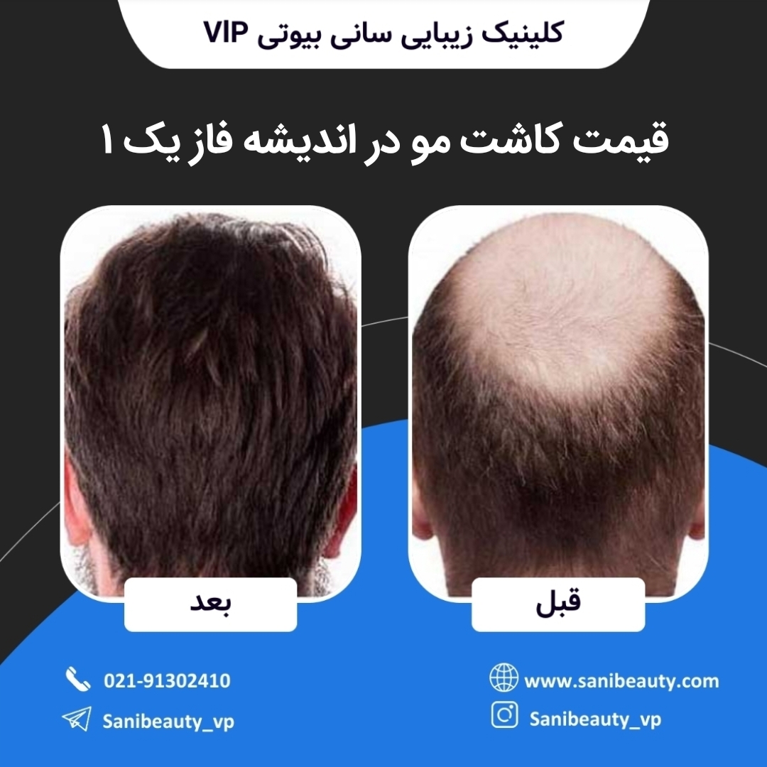 قیمت کاشت مو در اندیشه فاز یک ۱