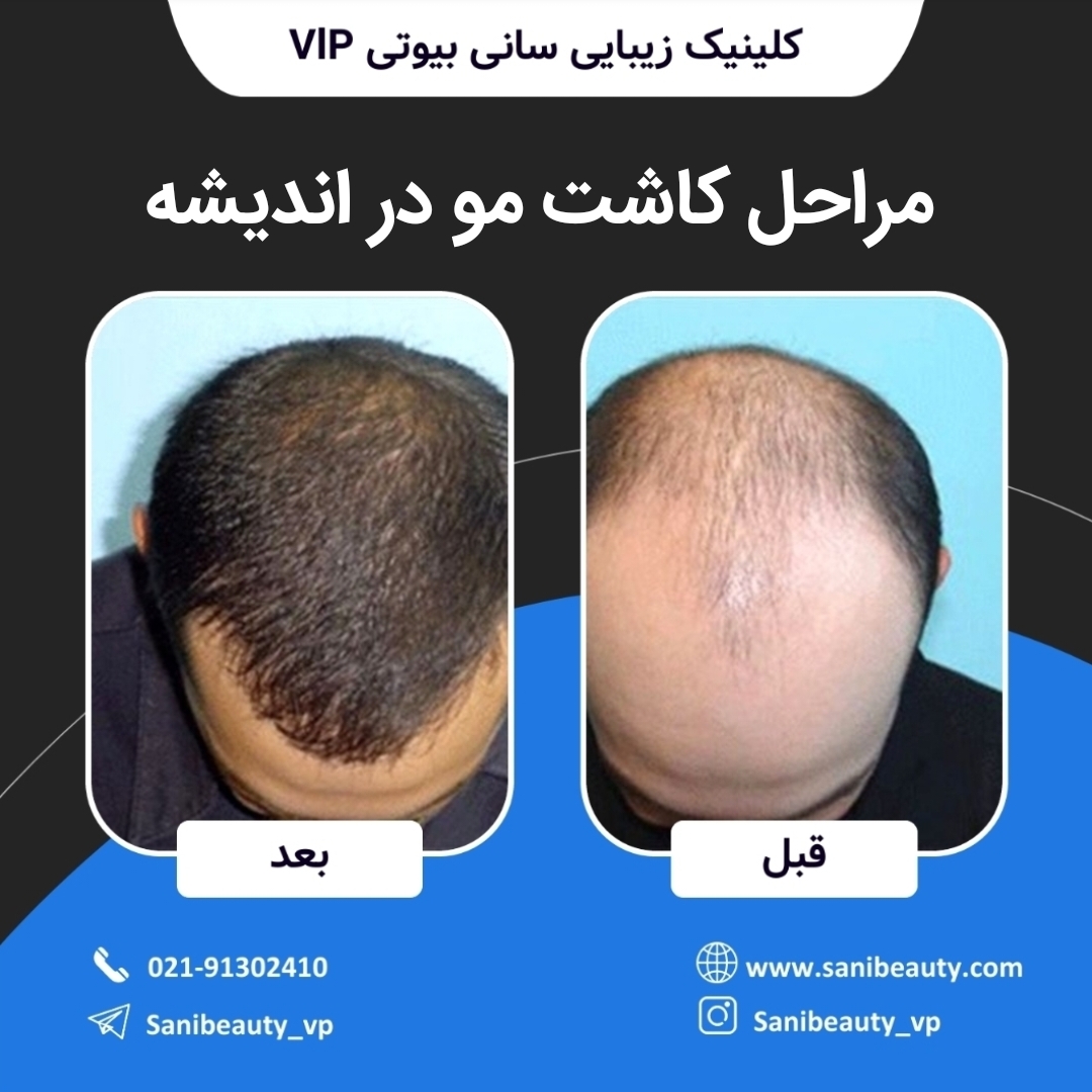 مراحل کاشت مو در اندیشه