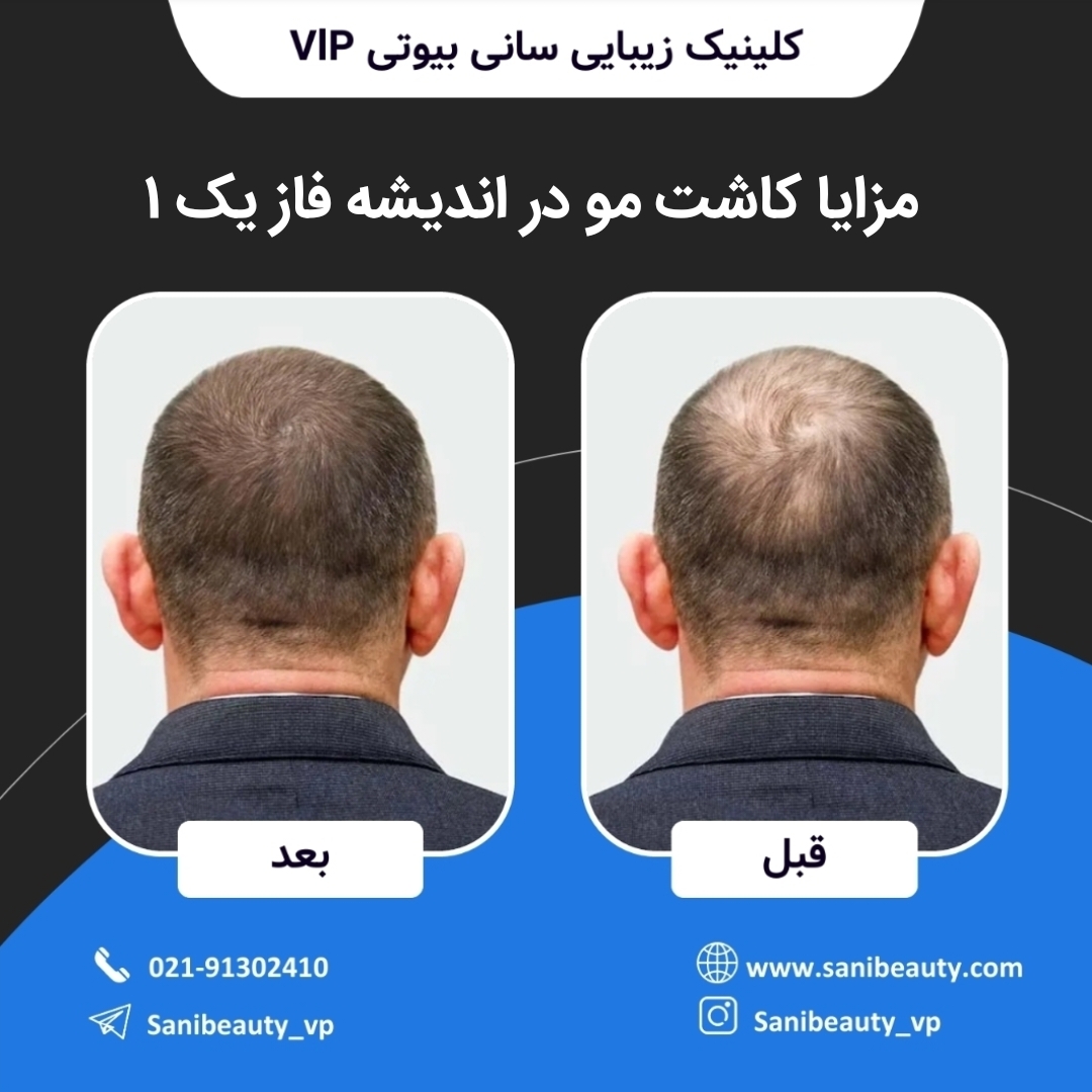 مزایا کاشت مو در اندیشه فاز یک ۱