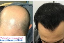 کلینیک کاشت مو اندیشه