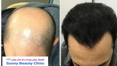 کلینیک کاشت مو اندیشه