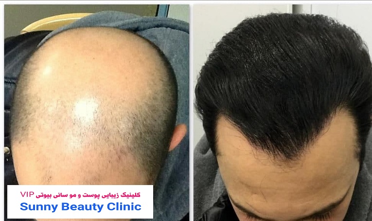 کلینیک کاشت مو اندیشه