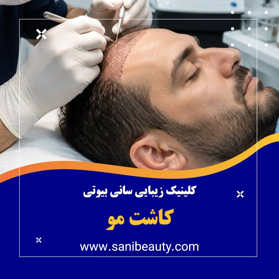 کاشت مو