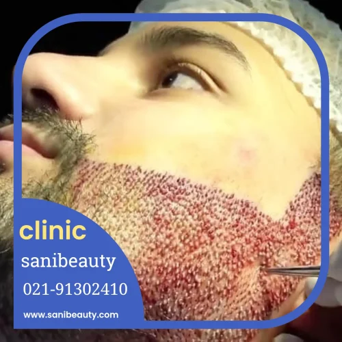 کاشت ریش و سبیل در اندیشه و شهریار